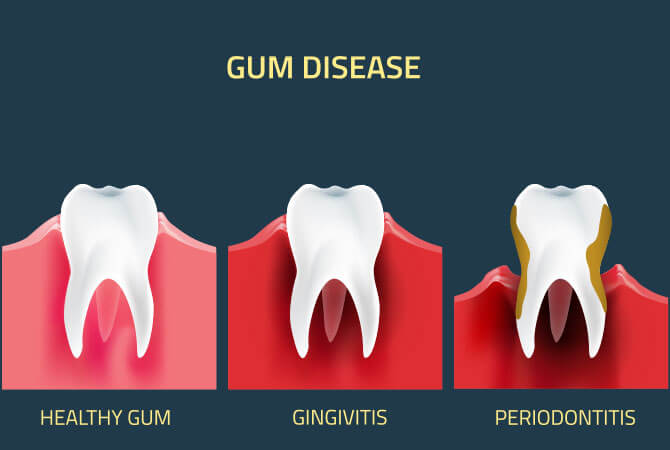 gum disease treatment in lincoln illinois