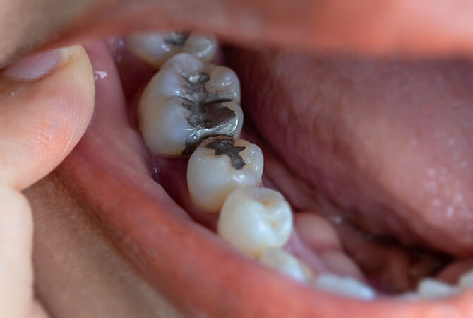 restorative dental fillings near central illinois